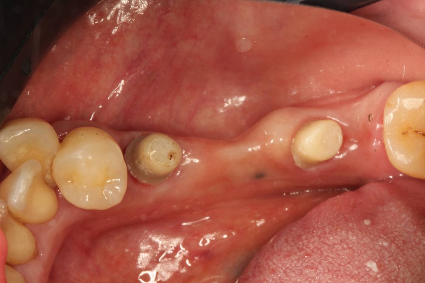 Dental Implants — Before