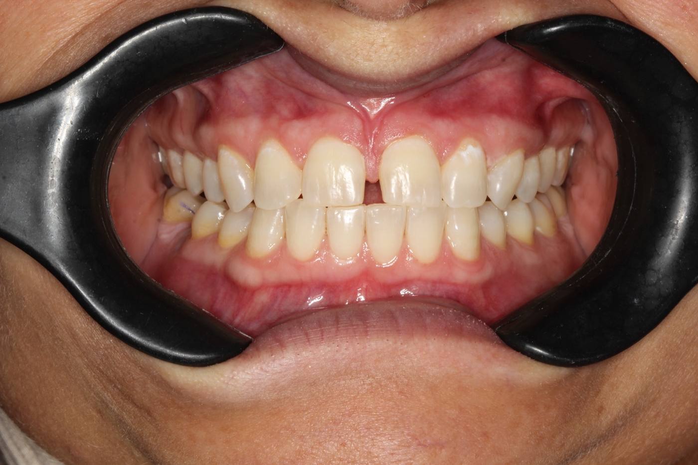Professional Whitening — After