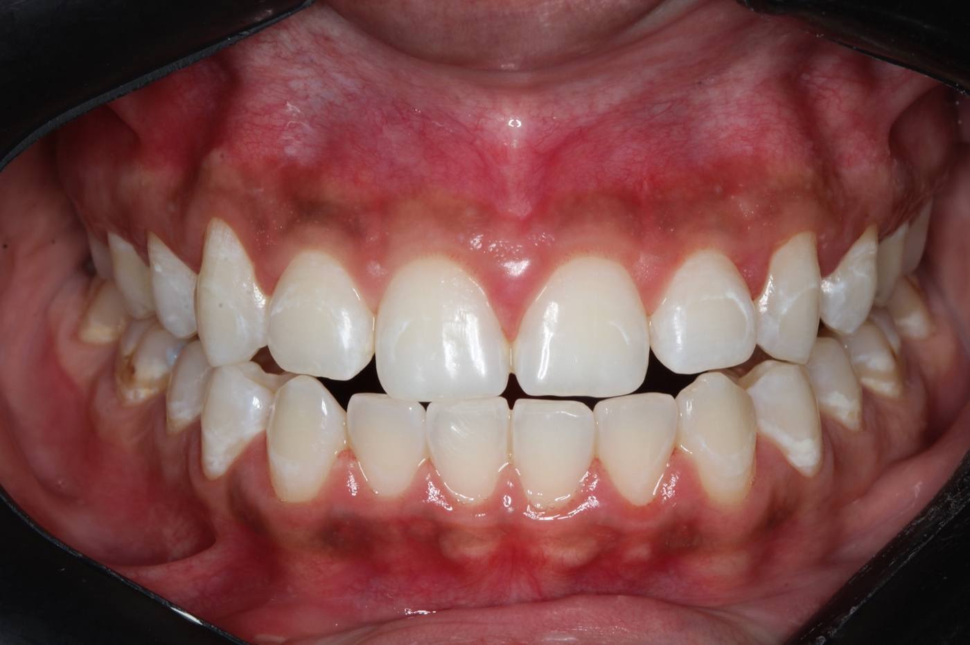 Professional Whitening — After