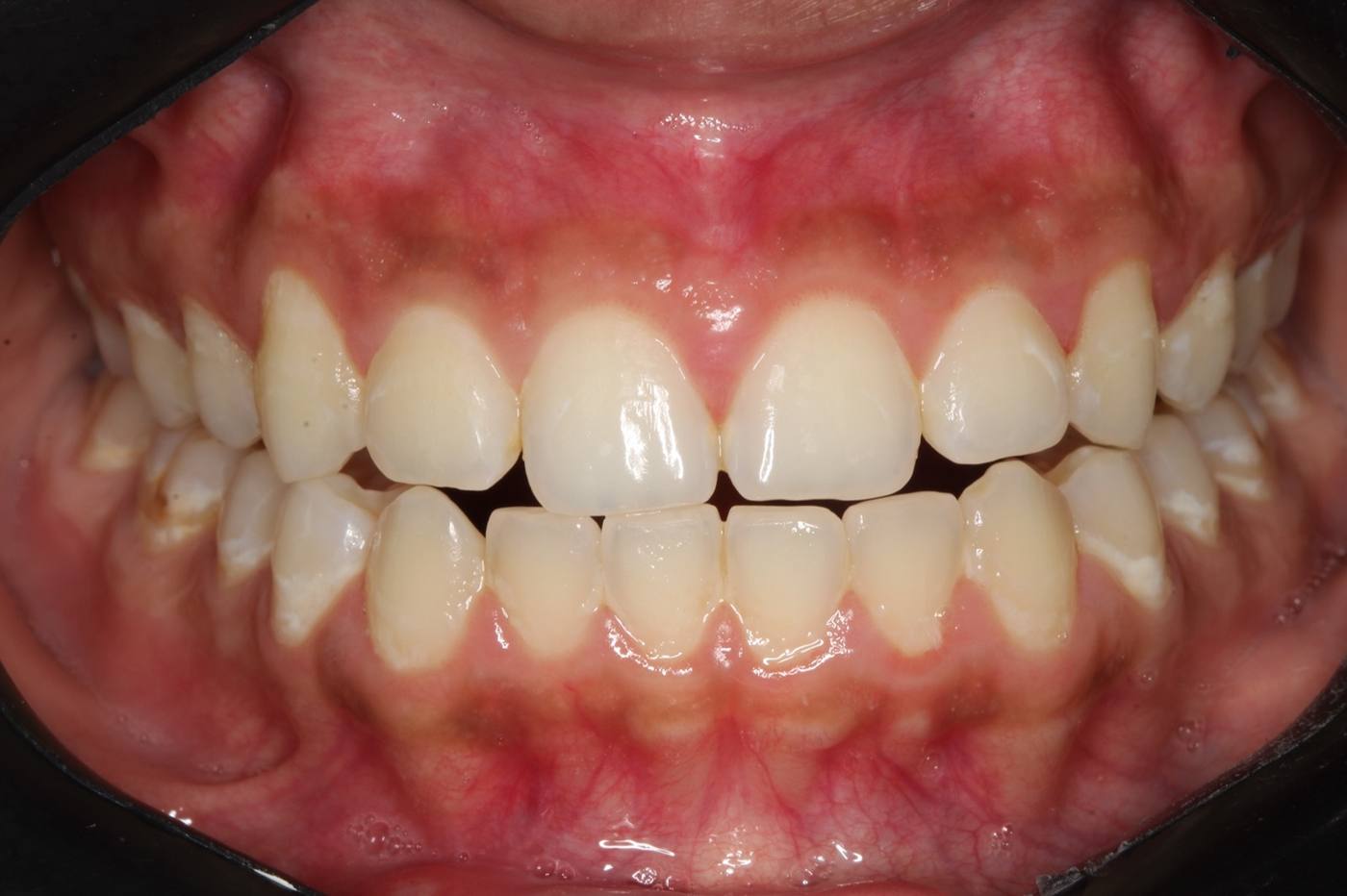 Professional Whitening — Before